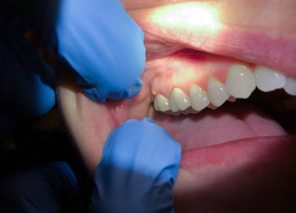 Best Emergency Dental Care for Broken or Chipped Teeth in Earlimart, CA